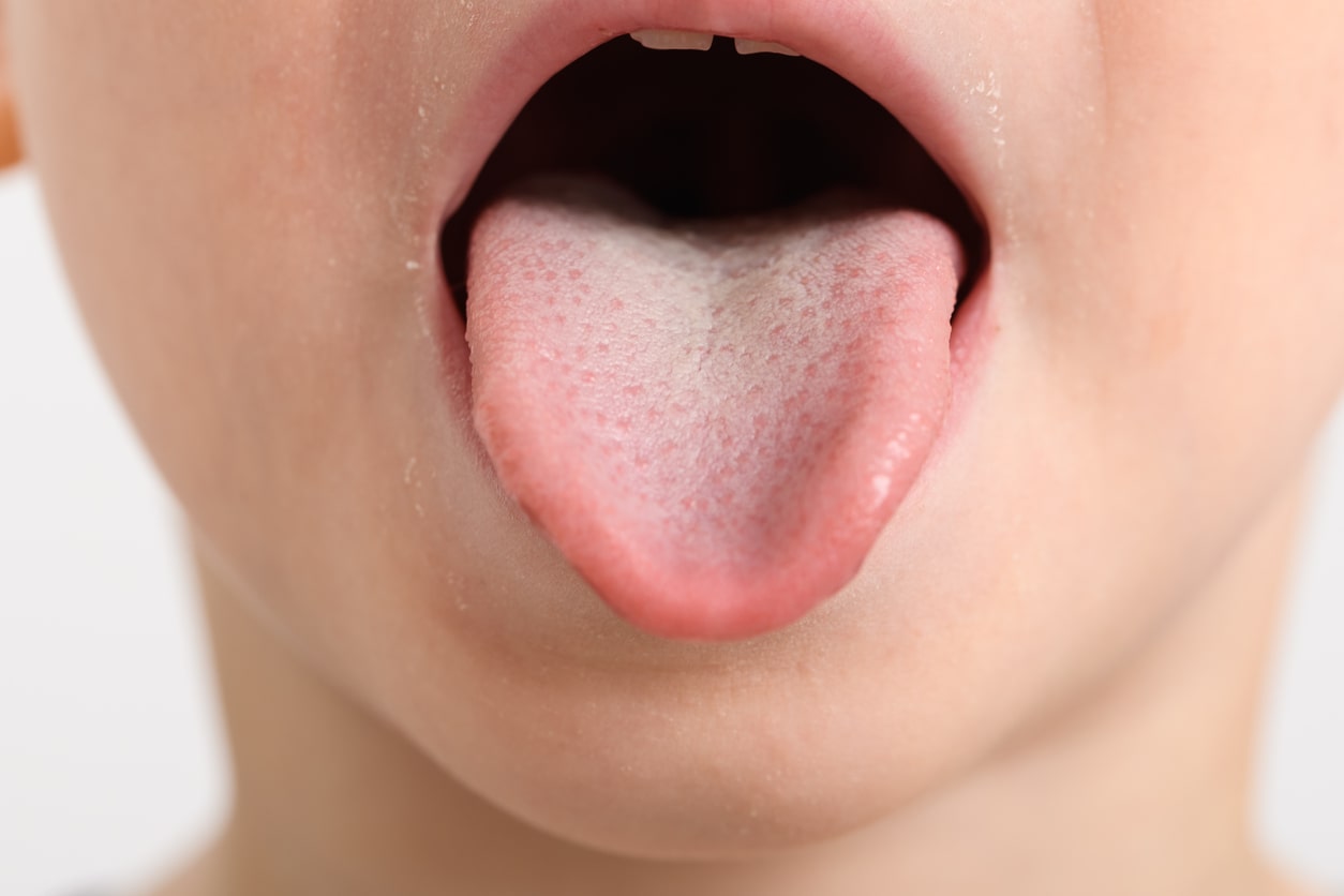 Oral thrush baby